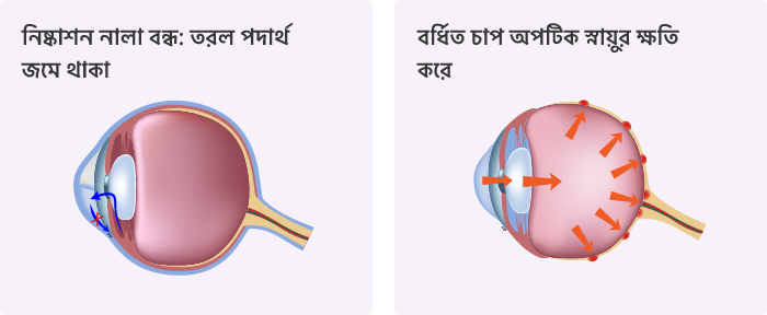 গ্লুকোমা কেন হয়?