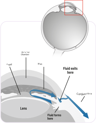 Diagram explaining insufficient drainage of aqueous humor fluid from the eye which leads to glaucoma