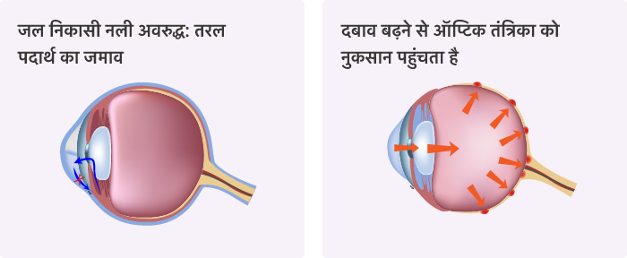 ग्लूकोमा के क्या कारण हैं?