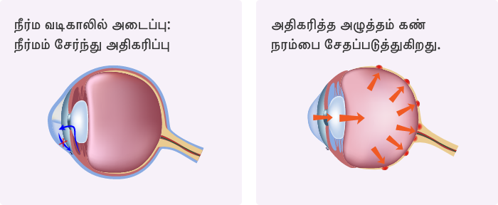 விழி விறைப்பு நோயை எது விளைவிக்கிறது?