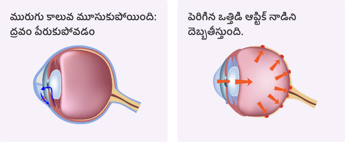 అసలు గ్లకోమా రావడానికి కారణమేమిటి?