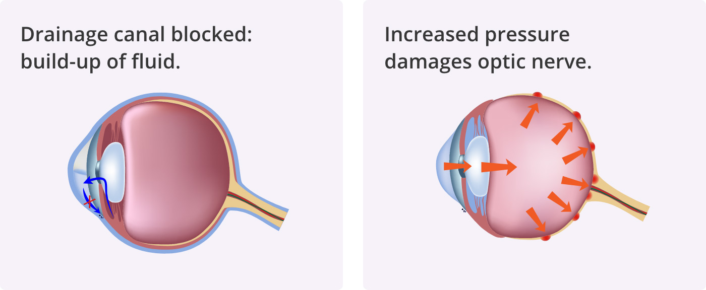 Drainage canal blocked: build-up of fluid Increased pressure damages optic nerve