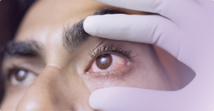 Glaucoma is a disease that damages the nerve of the eye, which relays information to the brain